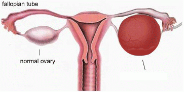 卵巢为什么会长囊肿？6个问题一次说清
