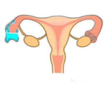 女性输卵管积水自己能成功自然怀孕吗?