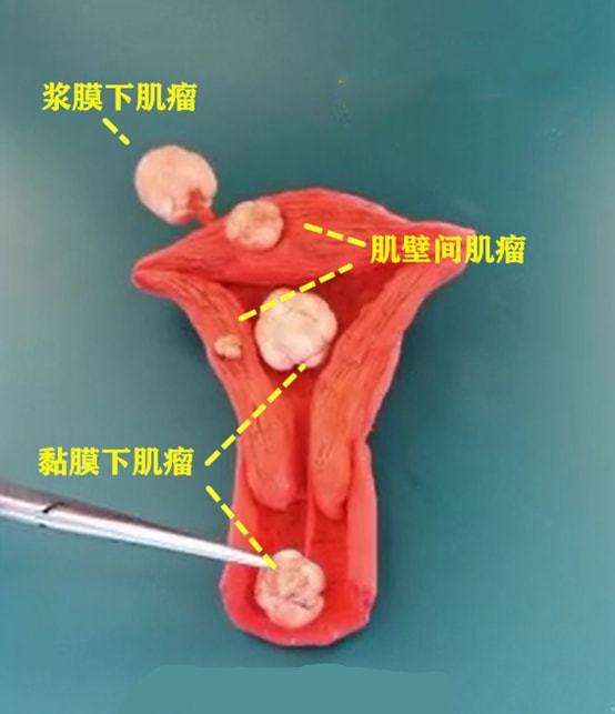子宫粘膜下肌瘤要怎么治