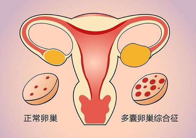 多囊卵巢综合征患者该如何恢复正常排卵？