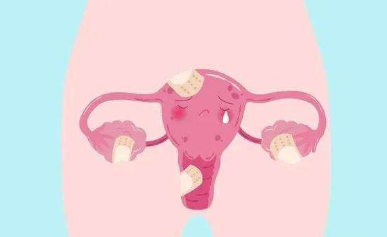 直肠子宫内膜异位症是什么病，能治好吗
