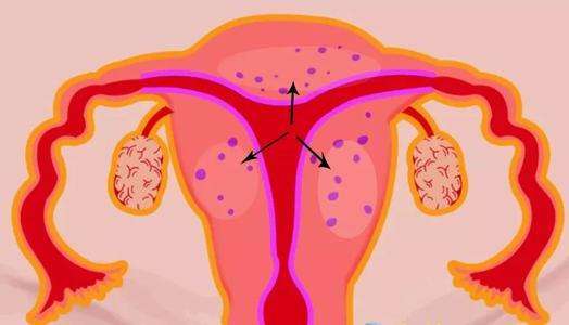 子宫腺肌瘤和不孕不育的关系