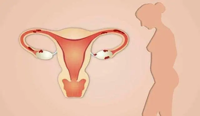 宫腔感染会出现什么症状