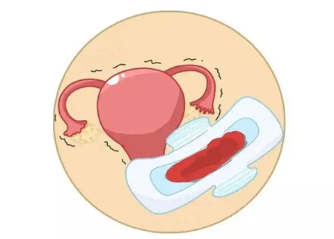 功能性子宫出血的症状和治疗方法