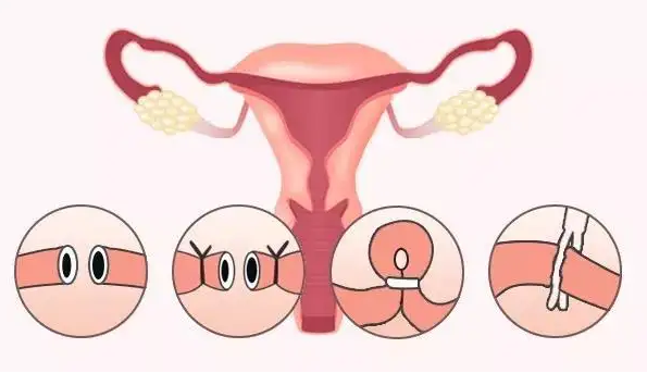 输卵管切除了还能接上吗，能不能恢复正常？