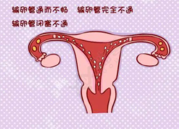 通输卵管手术要多少钱，通而不畅怀孕几率有多少？