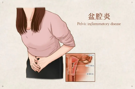 盆腔炎，女性生育路上的一大“拦路虎”