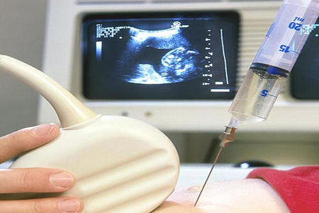 促排检测卵泡一般需要几次，第一次促排未孕