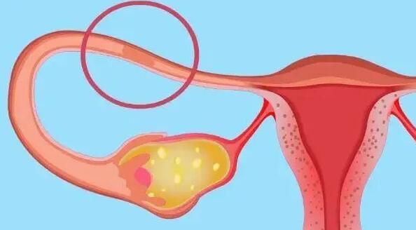 输卵管不通的治疗方法都有哪些