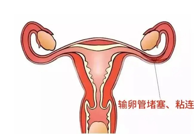 输卵管造影检查步骤是什么