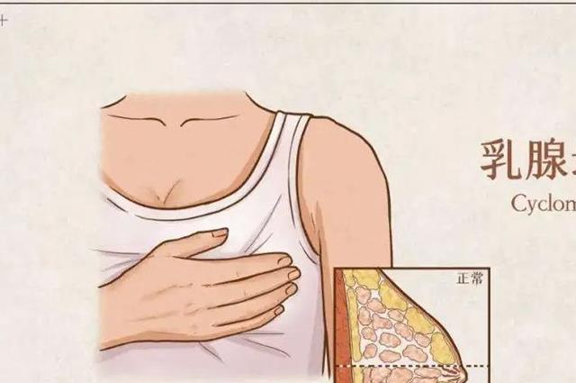 乳房痛是什么原因导致的？多半考虑为这5种原因