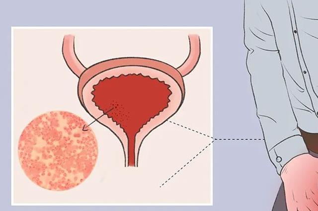 尿道炎是什么原因引起的？这4个导火索早知早避开