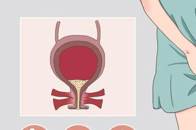 膀胱发炎有什么症状表现？这六点表现不容忽视