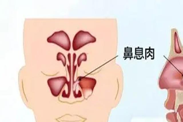鼻息肉有什么症状表现？身体会出现这6个异样