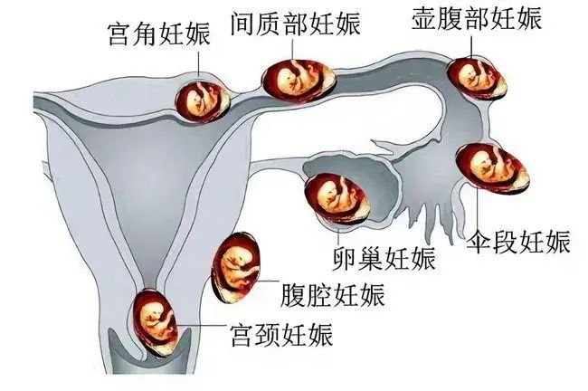 宫角妊娠