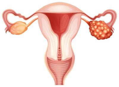 子宫肌瘤和囊肿能自己消失吗-妇科囊肿严重会不会割除子宫