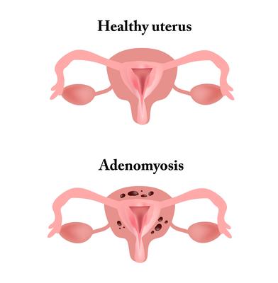 子宫周围炎服什么药好-子宫炎和盆腔炎如何区分