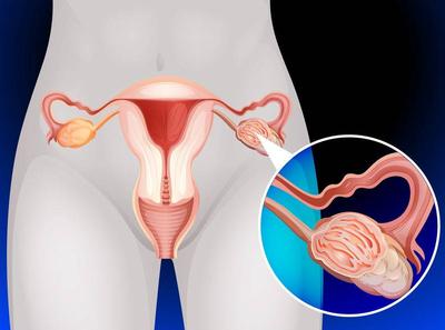 子宫异位有什么反应-产妇为什么会得子宫内膜炎