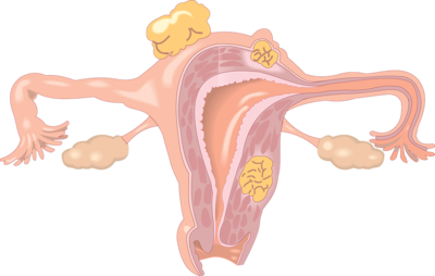 妊娠合并子宫肌瘤是常见的事 孕妇对此应该引起重视-绝经期妇女子宫肌瘤需治疗吗?