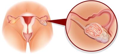 重庆医院输卵管粘连和卵巢囊肿的区别