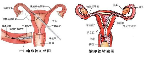 主页 女性不孕 病因      输卵管作为精卵结合的桥梁,只有一路畅通